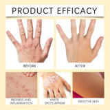 Vitigo Bee Venom Treatment Cream | Natural Skin Repair Hydration Relief Anti-Irritation